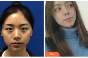 玉林時光醫(yī)療美容醫(yī)院李紅梅整形價格表附定點雙眼皮案例展示