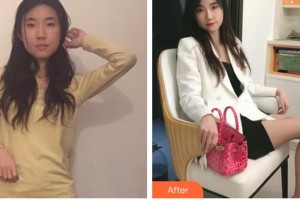 玉林市皮膚病防治醫(yī)院美容外科盧祖初整形價格表附玻尿酸精華導入案例展示