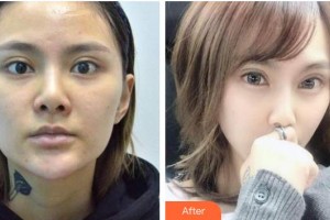 玉林愛爾眼科醫(yī)院周平整形價格表附眼部綜合案例展示