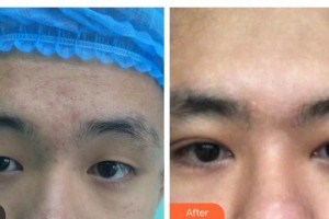 玉林愛爾眼科醫(yī)院羅志紅整形價格表附開內眼角案例展示