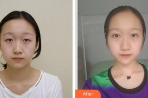 玉林時光醫(yī)療美容醫(yī)院陳鴻整形價格表附切開雙眼皮案例展示