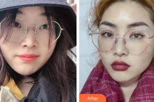 河池市中醫(yī)醫(yī)院眼科黃炳護整形價格表附眼部綜合案例展示