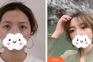 河池市中醫(yī)醫(yī)院眼科任武鵬整形價格表附切開雙眼皮案例展示