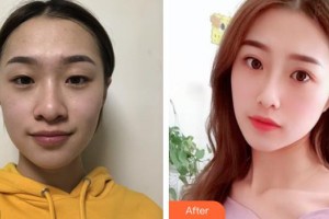 河池市中醫(yī)醫(yī)院眼科韋付林整形價格表附切開雙眼皮案例展示