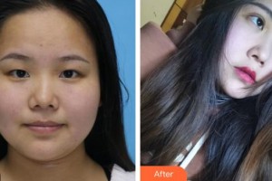 來賓市興賓區(qū)人民醫(yī)院眼科陳海軍整形價格表附眼部綜合案例展示