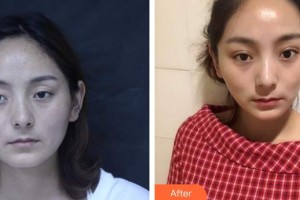 來賓市人民醫(yī)院眼科吳佳勢整形價格表附切開雙眼皮案例展示