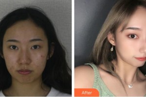 來賓市人民醫(yī)院眼科張鵬整形價格表附眼部綜合案例展示