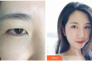 來賓市人民醫(yī)院眼科陳燕玲整形價格表附眼部綜合案例展示