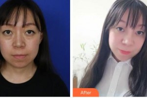 來賓市人民醫(yī)院眼科譚揚勇整形價格表附眼部綜合案例展示