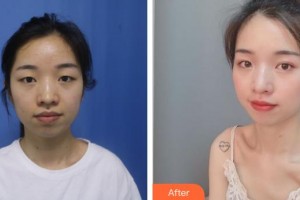 來賓市人民醫(yī)院眼科何發(fā)堅整形價格表附眼部綜合案例展示