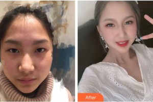 來賓市人民醫(yī)院眼科韋曉星整形價格表附眼部綜合案例展示