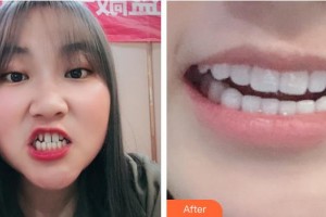 江陰艾爾美醫(yī)療美容診所安衛(wèi)平整形價格表附牙貼面案例展示