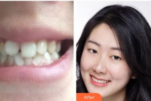 江陰東方女子醫(yī)院整形美容中心李藝恩整形價格表附冷光美白案例展示