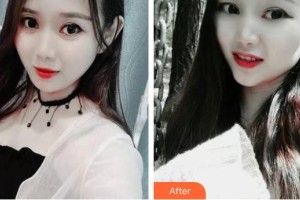 江陰市中醫(yī)院整形美容科袁冰峰整形價格表附金屬托槽矯正案例展示