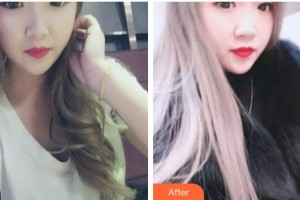 江陰牙博士口腔門診部董偉鵬整形價格表附金屬托槽矯正案例展示