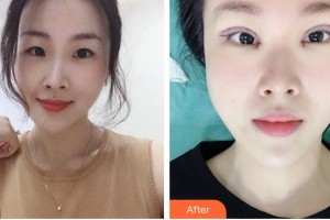 江陰艾爾美醫(yī)療美容診所井建民整形價格表附眼部綜合案例展示