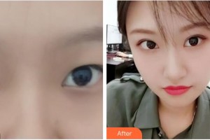 江陰市中醫(yī)院整形美容科陳偉中整形價格表附切開雙眼皮案例展示