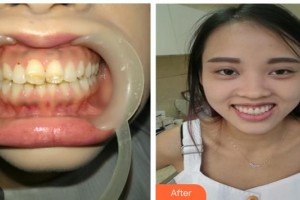 江陰牙博士口腔門診部裴洪來整形價格表附美白貼片案例展示