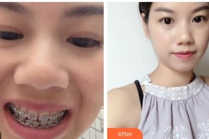 江陰牙博士口腔門診部范坤鵬整形價格表附金屬托槽矯正案例展示