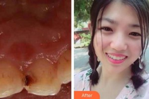 江陰牙博士口腔門診部宋旭杰整形價格表附美容冠案例展示