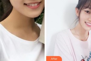 江陰金誠口腔門診部包崇云整形價格表附牙貼面案例展示