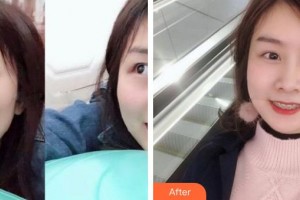 江陰金誠口腔門診部馬泉生整形價格表附金屬托槽矯正案例展示