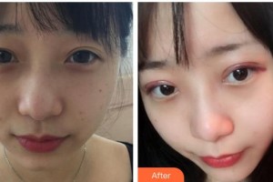 江陰光明眼科醫(yī)院石龍華整形價(jià)格表附眼部綜合案例展示