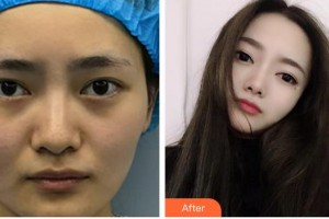 海南眼科醫(yī)院張秀蘭整形價格表附眼部修復案例展示