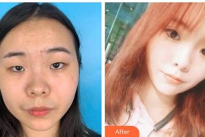 海南眼科醫(yī)院張秀妮整形價格表附定點雙眼皮案例展示