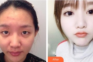 海南眼科醫(yī)院鐘興武整形價格表附眼部綜合案例展示