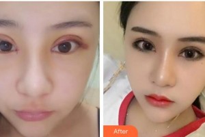 海南眼科醫(yī)院劉奕志整形價格表附切開雙眼皮案例展示