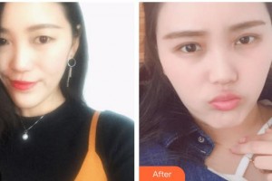 海南眼科醫(yī)院陳王靈整形價格表附眼部綜合案例展示