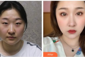 海南眼科醫(yī)院楊軍整形價格表附眼部綜合案例展示