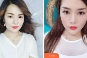 海南眼科醫(yī)院徐力整形價格表附眼部綜合案例展示