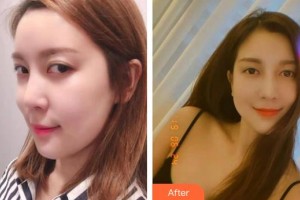 海南眼科醫(yī)院冼文光整形價格表附眼部修復案例展示