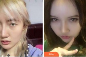 海南省中醫(yī)院眼科中心廖繼波整形價格表附切開雙眼皮案例展示