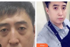 海南省中醫(yī)院眼科中心陳得謎住院醫(yī)師整形價格表附切開雙眼皮案例展示