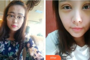 海南省中醫(yī)院眼科中心郭翠玲整形價格表附切開雙眼皮案例展示