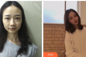 海南眼視光學中心門診部梁瓊整形價格表附切開雙眼皮案例展示