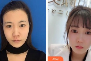 ?？跂|湖醫(yī)學美容整形醫(yī)院張文其整形價格表附去痘印痘坑案例展示