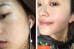 ?？邬i愛醫(yī)療美容醫(yī)院任秀麗整形價格表附激光祛斑案例展示