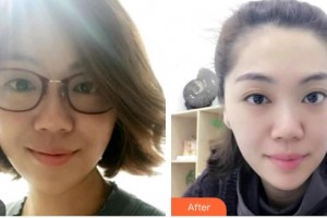 ?？诖揸匚尼t(yī)療美容診所崔曦文整形價格表附光子嫩膚案例展示