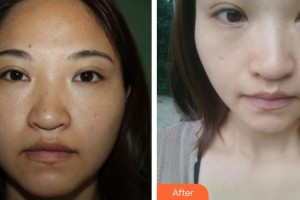 ?？谑械谒娜嗣襻t(yī)院眼科鐘羽麗整形價格表附清潔祛痘案例展示