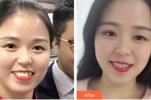 ?？诤佳谰S信口腔門診部李娜住院醫(yī)師整形價格表附自鎖托槽矯正案例展示
