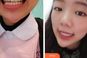 ?？诤佳谰S信口腔門診部樸光裕整形價格表附隱形托槽矯正案例展示