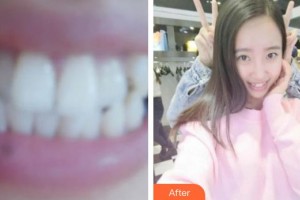 ?？诤佳谰S信口腔門診部楊惦山整形價格表附牙齒隱形矯正案例展示