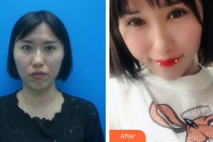 ?？诩t妝尚醫(yī)療美容門診部羅勇整形價格表附內切祛眼袋案例展示