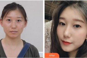 海口紅妝尚醫(yī)療美容門診部袁兆周整形價格表附切開雙眼皮案例展示