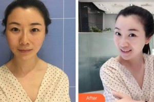 ?？诩t妝尚醫(yī)療美容門診部李楠整形價格表附埋線提升案例展示