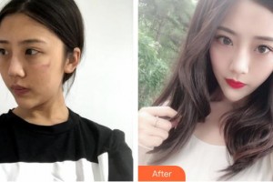 揚州第一人民醫(yī)院整形美容科雷岳崇整形價格表附微創(chuàng)疤痕修復案例展示